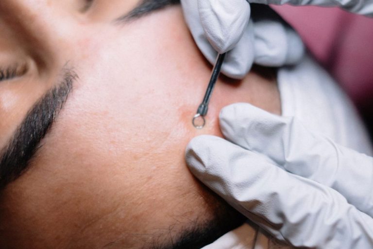 Extracția punctelor negre la un tratament facial profesional